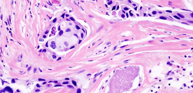 rakovina prsou (zdroj: wikipedia.org)
