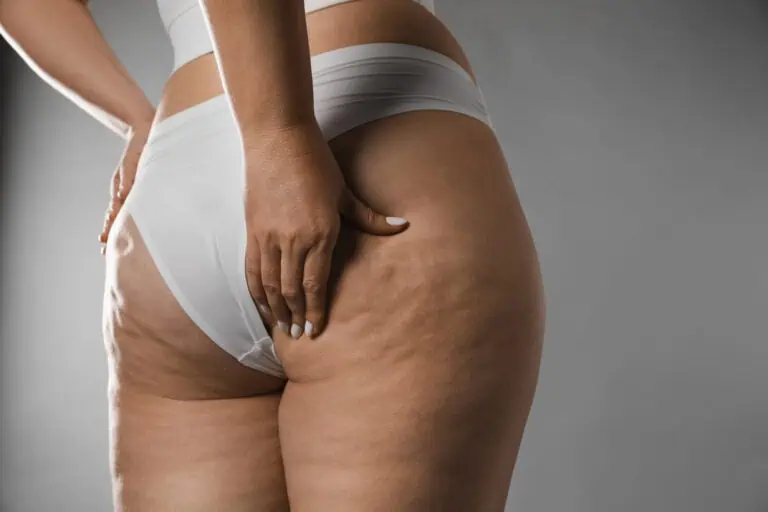 celulitida na hýždích